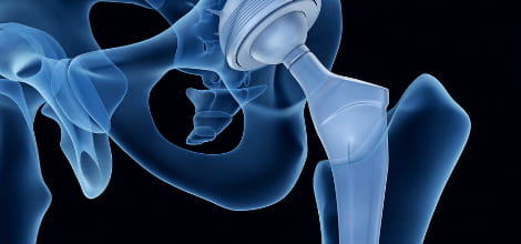 Image of a prosthetic hip in x-ray